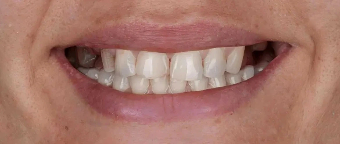Before implant treatment