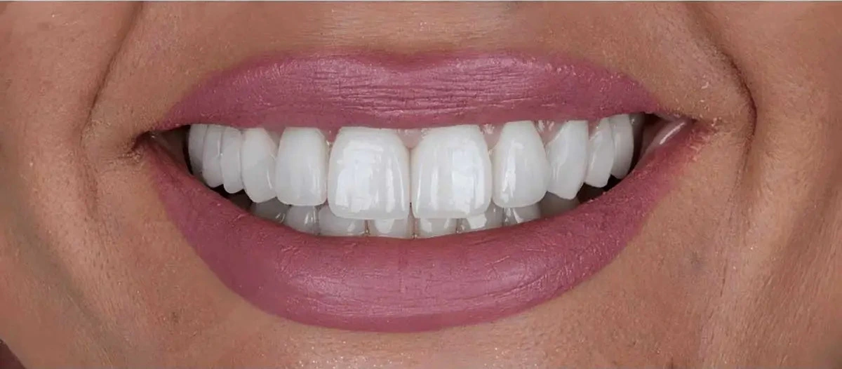 After implant treatment